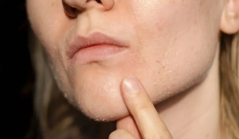 Die Haut der Frau schält sich am Mund ab. Trockene Haut.